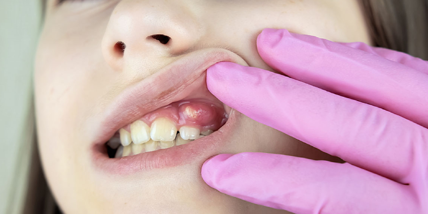 برای پیشگیری از آبسه دندان چه کار کنیم؟